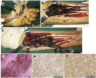 Case report: A rare case of massive peripheral nerve melanotic schwannoma and review of the literature